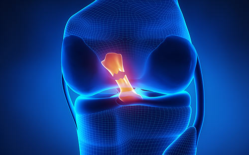 Anterior cruciate ligament knee injury causes symptoms treatment and recovery