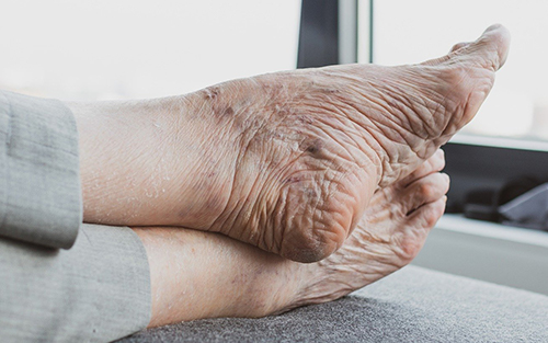 Aging feet begin to appear wrinkled and develop physical problems