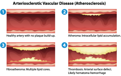 Leg pain atherosclerosis artery blockage description