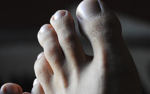 Athletes foot treatment and prevention for clear skin