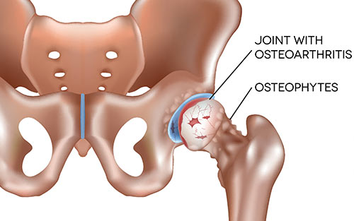 Hip bone spurs or osteophytes cause reduced mobility and severe pain requiring intense therapy or surgery