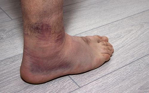 swollen ankles can be caused by several illnesses