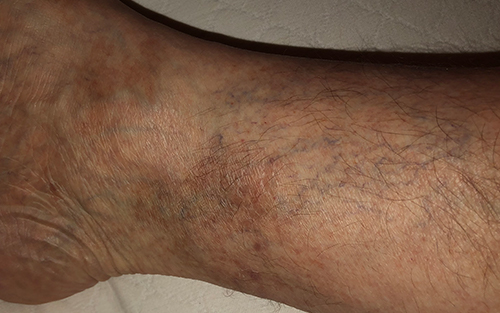 Venous insufficiency can be an underlying condition of vericose veins