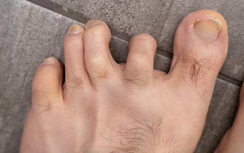 Common foot problems claw toe