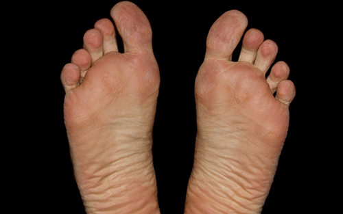 Aging feet require more care and attention