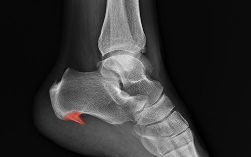 Common foot problems heel spurs
