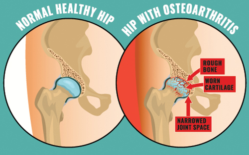Hip replacement surgery osteoarthritis condition