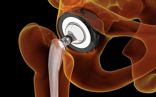 Hip replacement surgery ball and socket joint