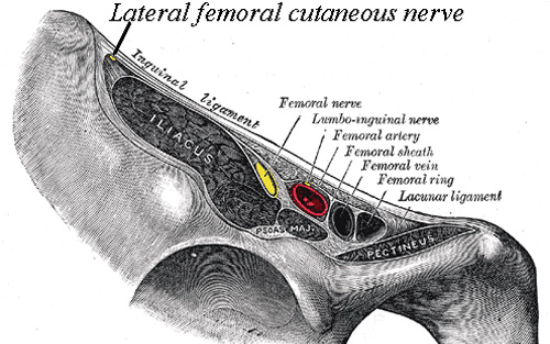 Meralgia paresthetica caused from lateral femoral cutaneous nerve compression