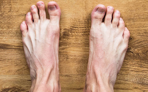 Common foot problems metatarsalgia
