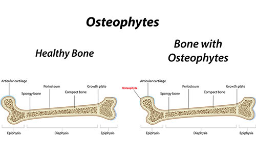 Bone spur growth on bone
