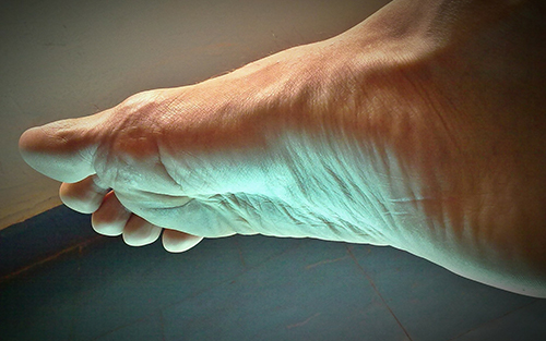 Common foot problems peripheral neuropathy