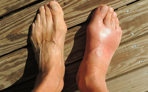 Swollen foot from plantar fasciitis symptoms