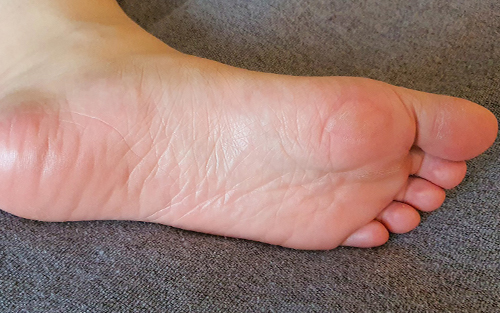 Common foot problems plantar fasciitis