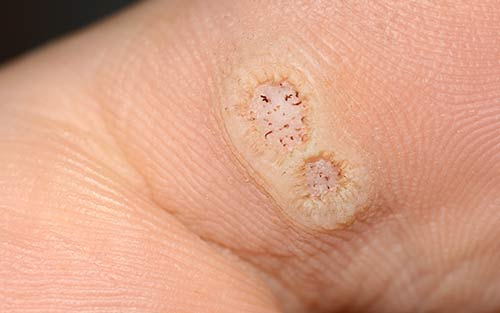 Plantar warts caused by a virus verruca plantaris and causing foot discomfort