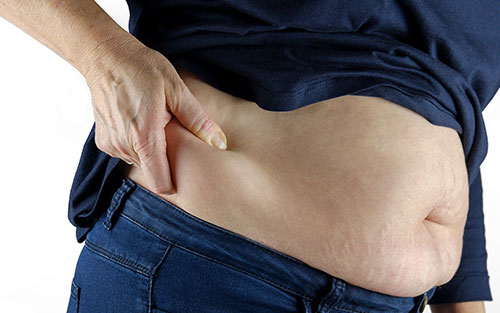 Sciatic nerve pain caused by obesity and poor posture