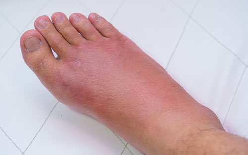 Swollen sprained ankle requiring medical attention