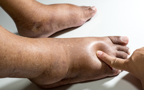 Swollen feet occur for a vast amount of reasons including injuries and illnesses