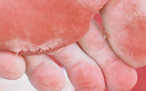 Athletes foot symptoms and treatment tinea pedis