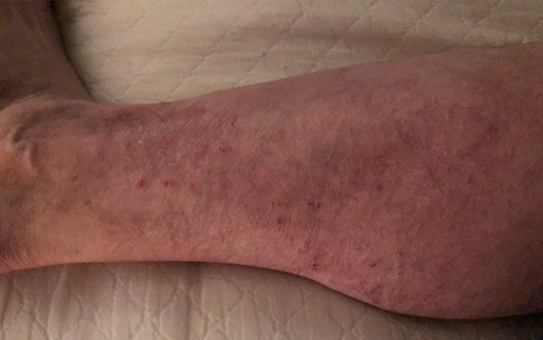 Venous insufficiency is a common and correctable condition