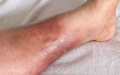 Swollen feet can develop with venous insufficiency